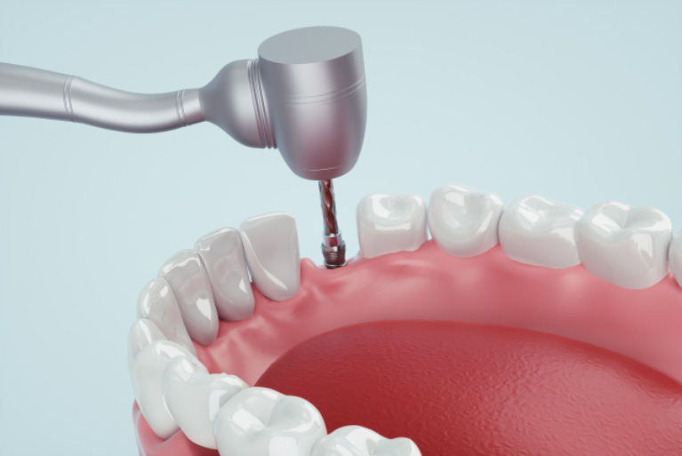 インプラント（人工歯根）の埋入手術