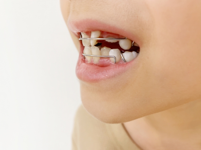 お子さまの矯正治療について