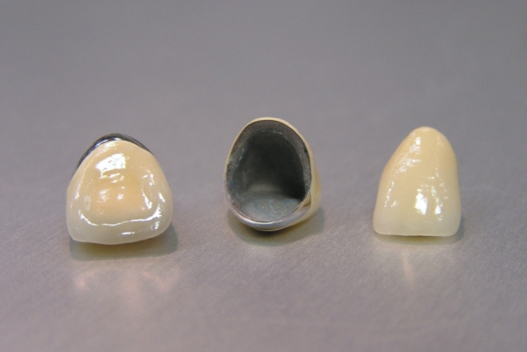 セラミックスメタルボンドクラウン