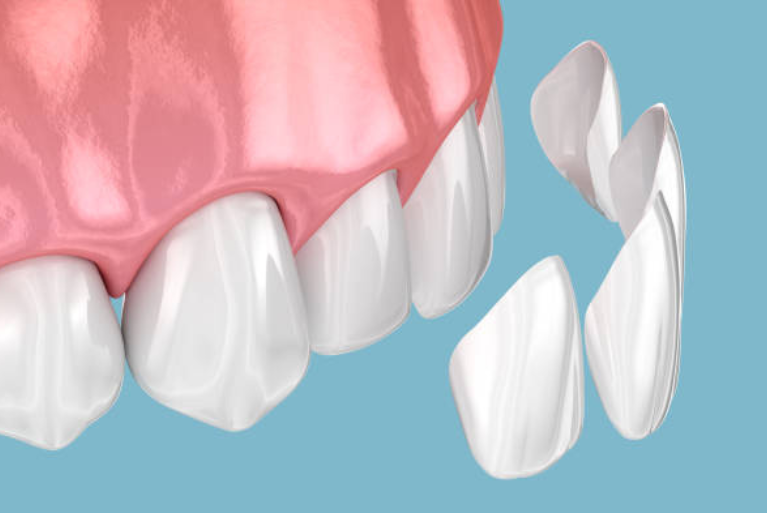 セラミックスラミネートベニア